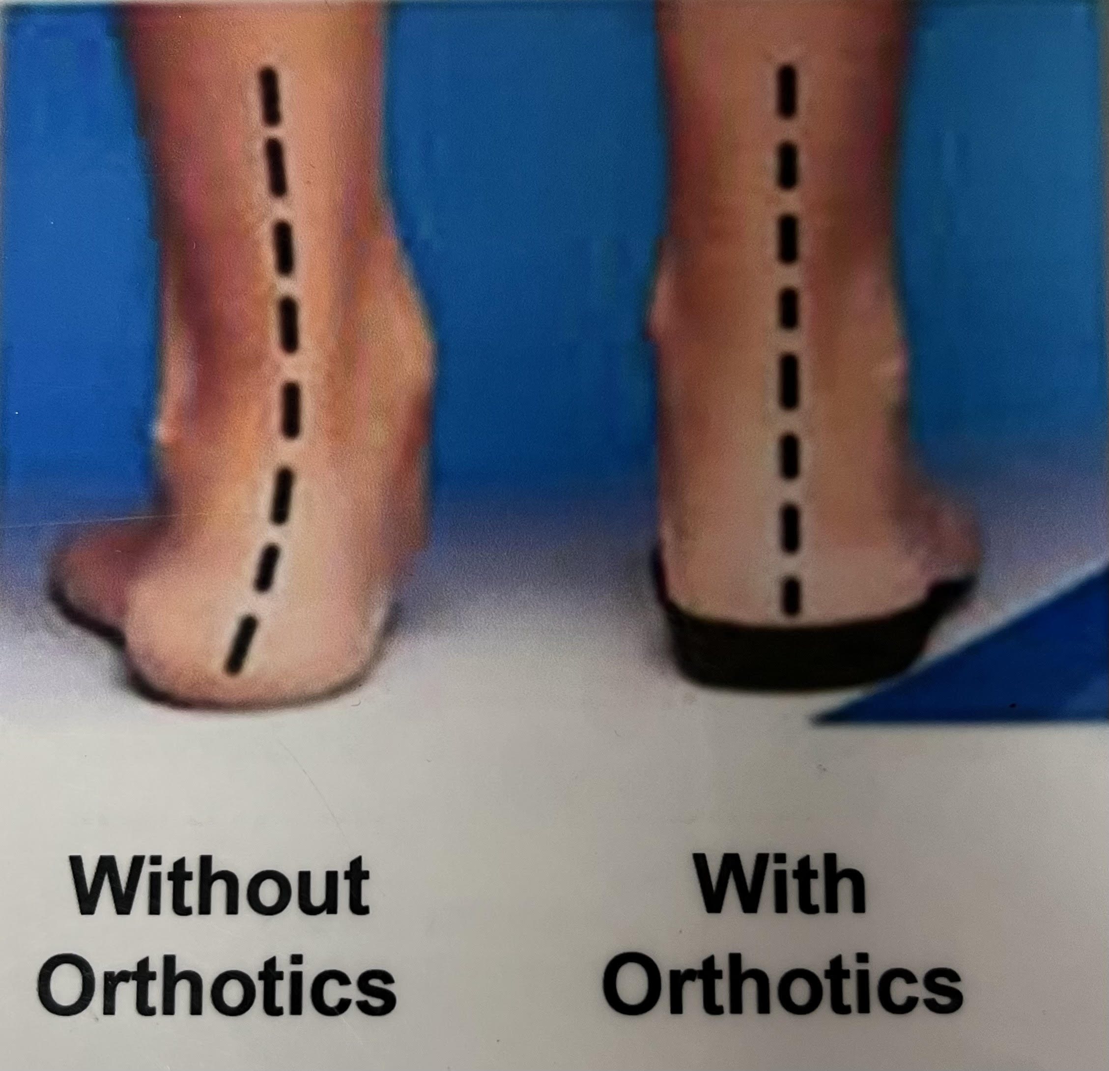 Dr. Powers Orthotics – Powers Orthotic Innovation